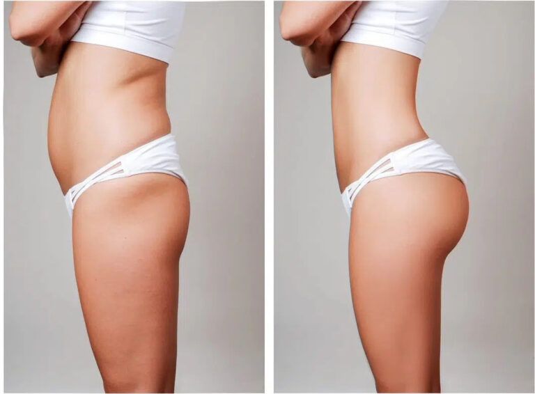 Non-Invasive Hip Lift Explained: Tips, Advice, and Practical Insights to Help Learn