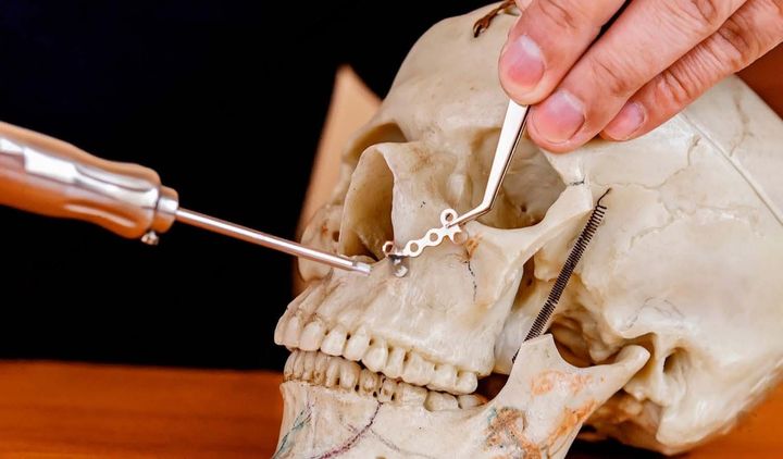 Maxillofacial Implant Manufacturing Basics: Learn How Modern Implants Are Created